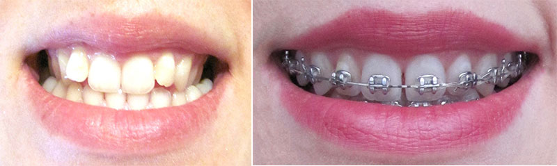 aparat-dentar-inainte-dupa-18-luni