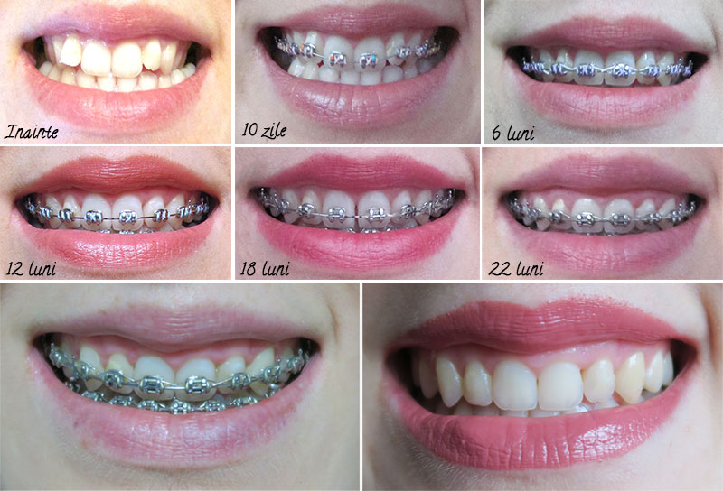 Aparatul dentar invizibil: 6 beneficii importante