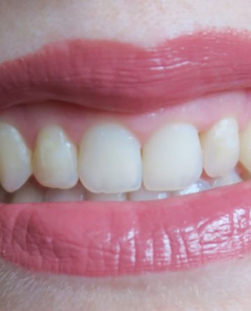 aparat-dentar-rezultat-final